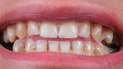 špatně vyčištěné zuby